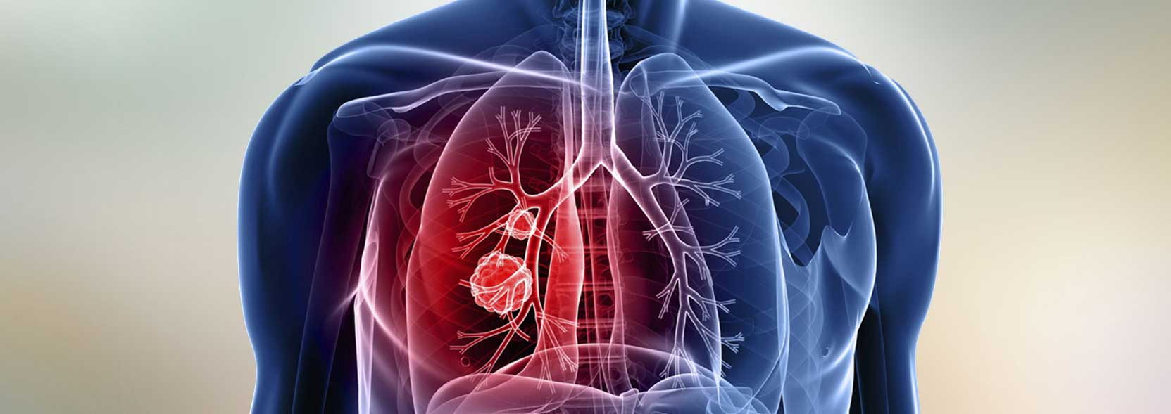 NSCLC NSCLC